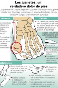 causas y tratamuentos de los juanetes