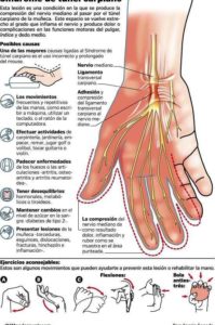 síndrome de túnel carpiano