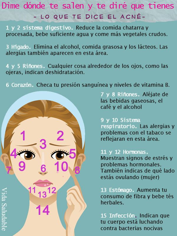infografía acné