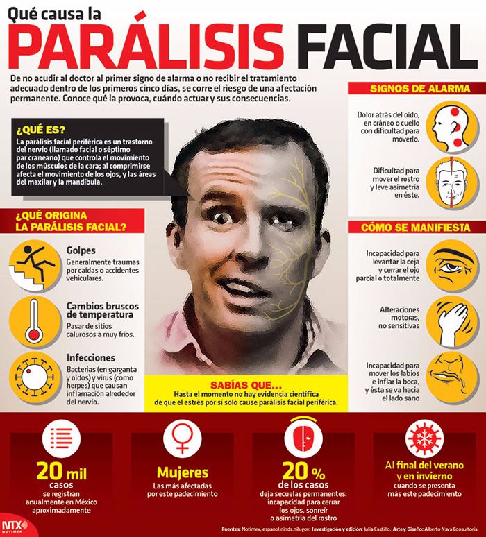 parálisis facial