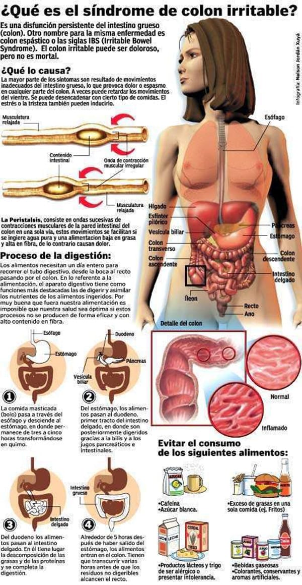 infografía sobre el colon irritable