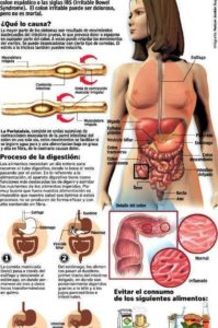 infografía sobre el colon irritable